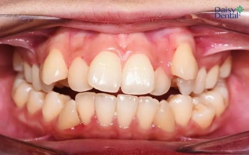 Người gặp tình trạng răng khấp khểnh không thuận tiện khi sử dụng miếng dán